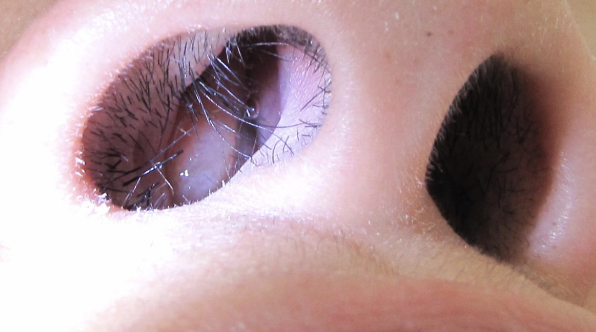 염증으로 부어있는 코 점막