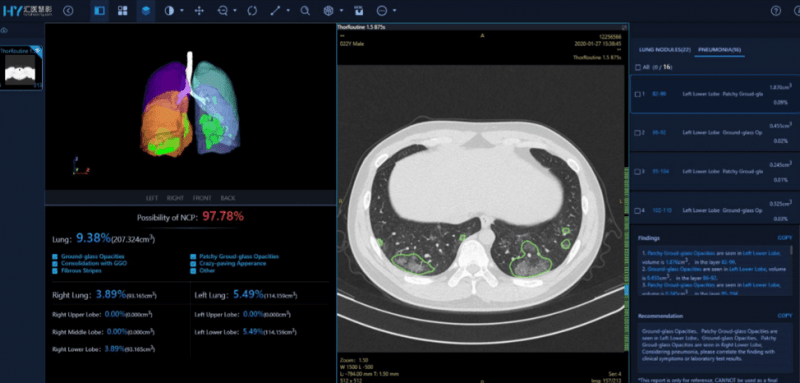 AI-powered CT scan analysis of lungs