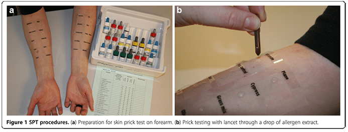 알레르기 피부반응검사 과정