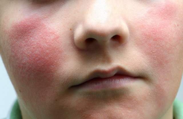 안면홍조 증상