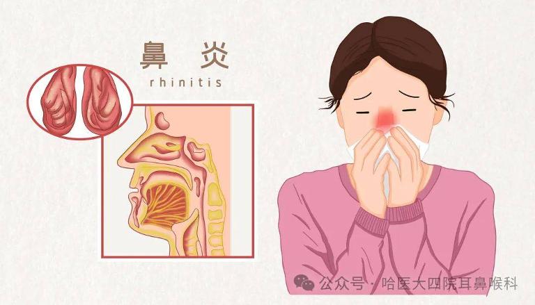 鼻子有哪些常见的疾病第2张